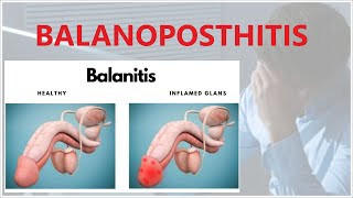 BALANOPOSTHITIS is a condition that affects the penis [upl. by Stephie]