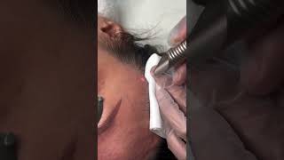 Unwanted lesion  Lesion Removal in Vancouver BC skincare confidentskin [upl. by Hamirak122]