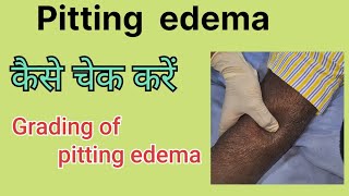 Pitting edema How to examine pitting edema Grades in pitting edema [upl. by Haroved395]