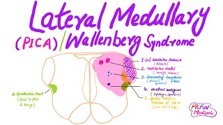 Wallenberg syndromePICALateral Medullary syndromeUSMLE [upl. by Sumerlin274]