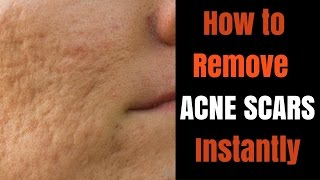 Instant acne scar removal [upl. by Haleehs766]