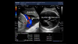 Ultrasound Video showing Cephalopelvic disproportion due to Hydrocephalus [upl. by Esinnej]