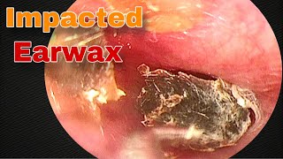 Impacted Ear Wax Removal  Doctor Anh [upl. by Dusa]