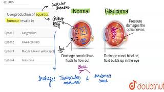 Overproduction of aqueous humour results in [upl. by Norrie290]