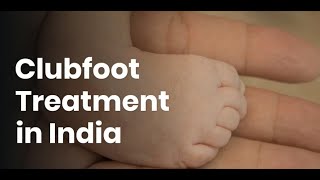 Clubfoot Treatment in India  Clubfoot Treatment Cost in India [upl. by Ahsinirt]