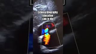 Patent foramen ovale echocardiography [upl. by Enaujed369]