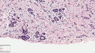 Tubulolobular Carcinoma Breast  Histopathology [upl. by Notterb]