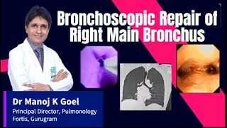 Bronchoscopic Dilatation Bronchial Stenosis Dr MANOJ GOEL lungcancer tuberculosis bronchoscopy [upl. by Tammany]