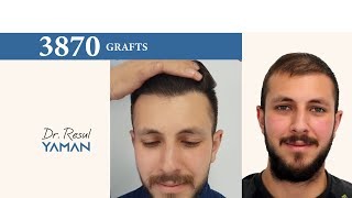 Dr Resul Yaman Hair Clinic  3870 Grafts Result [upl. by Frydman997]