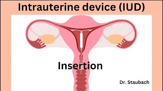 IUD Insertion What You NEED To Know ACTUAL FOOTAGE [upl. by Sneed221]