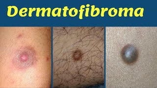 Dermatofibroma treatment hard bump on leg  चमड़ी में सख़्त गाँठ का कारण  इलाज  Dr Uttam Lenka [upl. by Cairns]