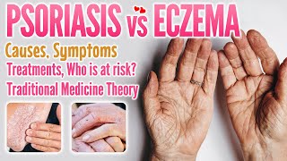 Psoriasis vs eczema causes symptoms treatment traditional medicine theory comparison [upl. by Breen239]