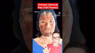 ALARMING CHEMICAL PEEL  Full Phenol Peel Process shorts [upl. by Anallij]