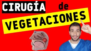 ⚠️ Cirugía de VEGETACIONES adenoidectomía ¿Cuáles son los RIESGOS y POSTOPERATORIO ✅ [upl. by Arec]