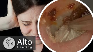 Ear Wax Removal CURES Tinnitus [upl. by Clem212]