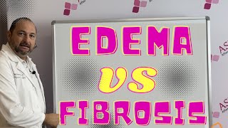 Edema VS Fibrosis Whats the Difference Liposuction Contour Irregularity  Lipo Lumps and Bumps [upl. by Dranoc]