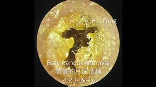 Easy earwax removal简单的耳屎清理20230916 [upl. by Terris170]