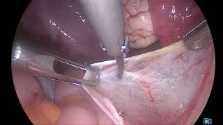 Lap excision of incidentally found deep endometriosis in a patient with mucinous ovarian cyst [upl. by Candy]