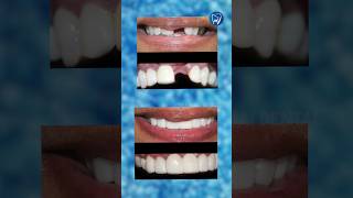 Tooth loss அ bridging technique மூலமா எப்படி சரி பண்ணலாம் [upl. by Shipley]