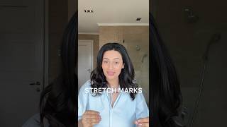 How To AvoidTreat Stretch Marks [upl. by Aihselat]