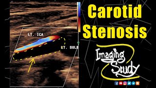 Carotid Artery Stenosis  Ultrasound  Doppler  Case 133 [upl. by Chemush]