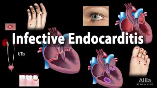 Infective Endocarditis Animation [upl. by Nossaj]