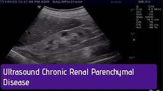 Ultrasound  How to Diagnose Chronic Renal Parenchymal Disease [upl. by Boaten]