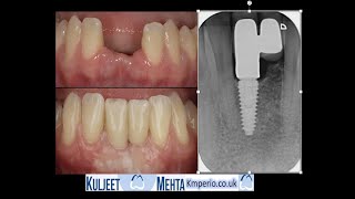 Dental Implant Cantilever bridge 3D Planning Flap less [upl. by Fawn]