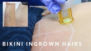 How to get rid of ingrown hairs with laser hair removal [upl. by Kynan373]