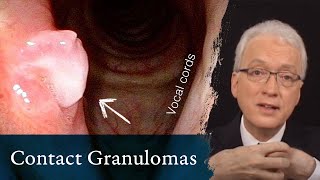 Contact Granulomas or Contact Ulcers [upl. by Bocyaj]