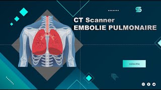 CT Scanner EMBOLIE PULMONAIRE  Partage de pratiques [upl. by Aneeled582]