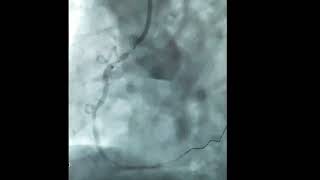 Ostial RCA stenting  90 seconds guide [upl. by Kopaz278]