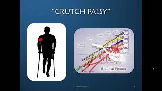 Radial Nerve Rehabilitation amp Orthotic Intervention Part 1 of 5 The Radial Nerve [upl. by Almeida633]