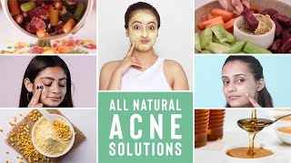 Causes amp Ways To Treat Acne In Humid Weather Conditions  Home Remedies  Humid Weather Series Ep 4 [upl. by Ybrek443]