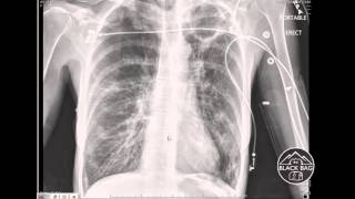 Xray Interpretation  Cavitary Lesions [upl. by Moshell]