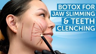 Botox for Jaw Slimming and Teeth Clenching  AAFE [upl. by Marilla141]