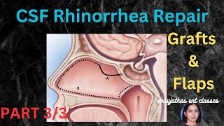 236Endoscopic Repair CSF Rhinorrhea Grafts and Flaps Part 33 surgeryeducation dentallectures [upl. by Imis]