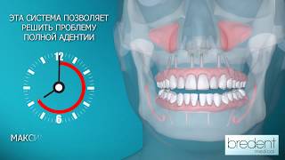 Система Fast amp Fixed Лечение беззубых челюстей за один день [upl. by Bremer]