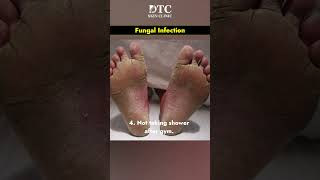 What is Fungal Infection amp Its Treatment  DTC Skin Clinic [upl. by Etnoel896]