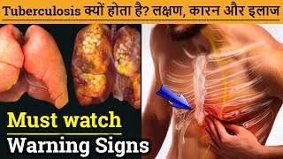 Tuberculosis क्यों होता है लक्षण कारन और इलाज Tuberculosis Symptoms Causes Treatment [upl. by Allanson397]