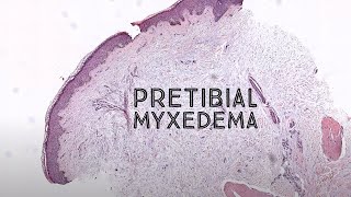 Pretibial myxedema Graves disease thyroid dermopathy pathology dermpath dermatology USMLE [upl. by Jessika]