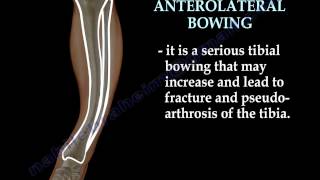 Tibial Bowing  Everything You Need To Know  Dr Nabil Ebraheim [upl. by Ia]