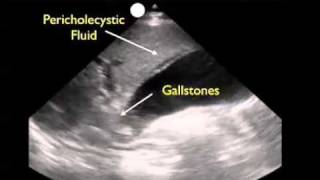 How To Gallbladder Ultrasound Part 3  Acute Cholecystitis Case Study Video [upl. by Beasley]