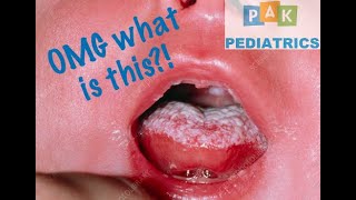 Tongue infection Newborn Oral thrush and treatment  Let’s Talk About [upl. by Nerrawed]