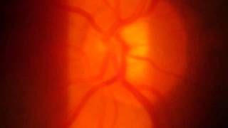 Optic Nerve Head Spontaneous Venous Pulsations [upl. by Ramma]