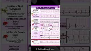 ECG Rhythms That are Tricky A Quick Look shorts [upl. by Badr]