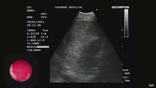 EBUS  Intranodal Cryobiopsy  Sarcoidosis [upl. by Leuqram]