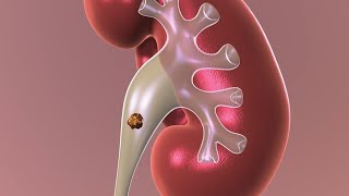 Observation Nonsurgical Approach to Kidney Stones [upl. by Lucita]