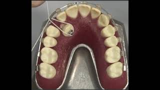 كيف يتم تقويم الأسنان؟comment redresser les dents [upl. by Einhpad921]