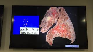 Introduction to Lung Pathology [upl. by Jovia118]